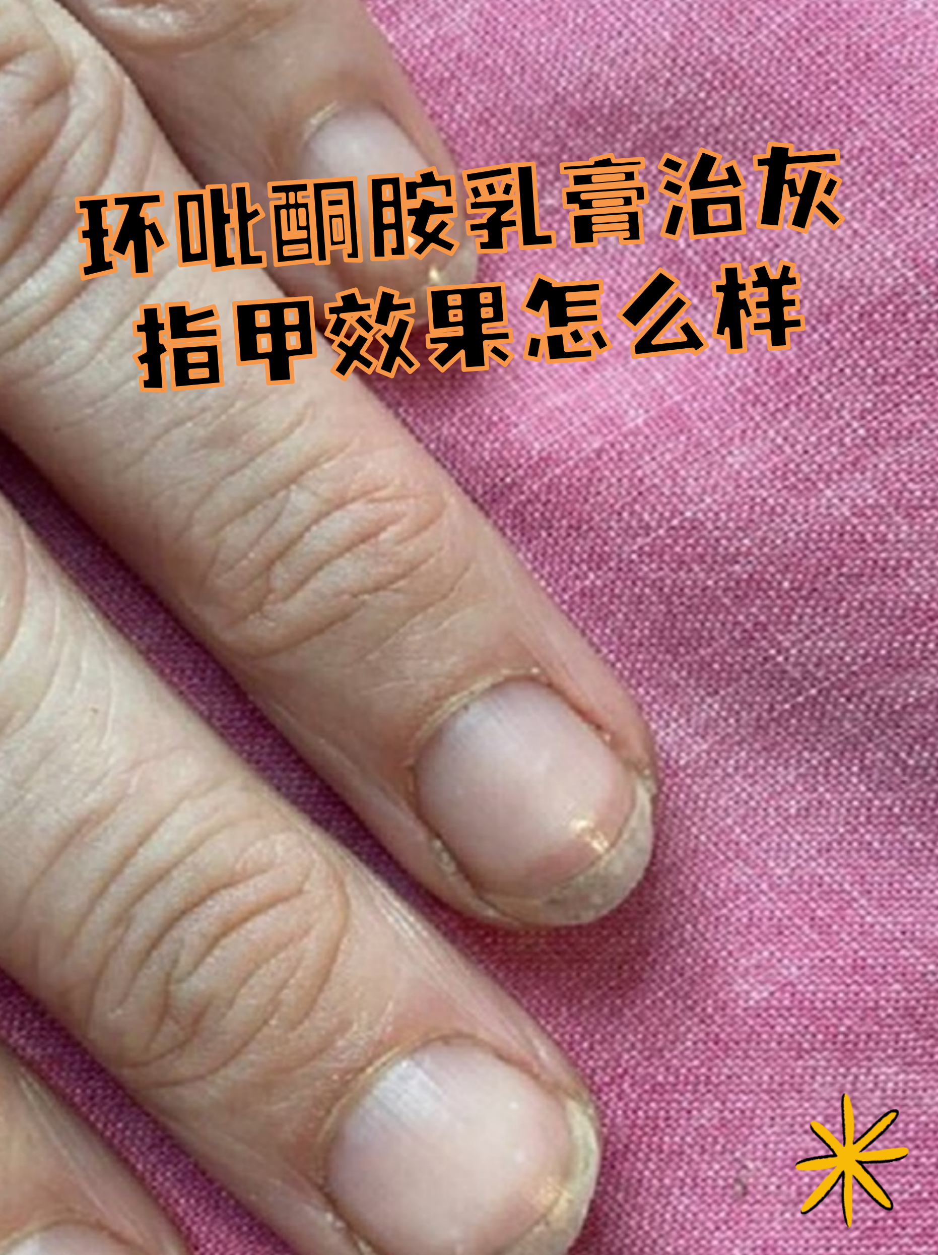 治疗灰指甲药的排名.治疗灰指甲的药都有哪些？-第2张图片